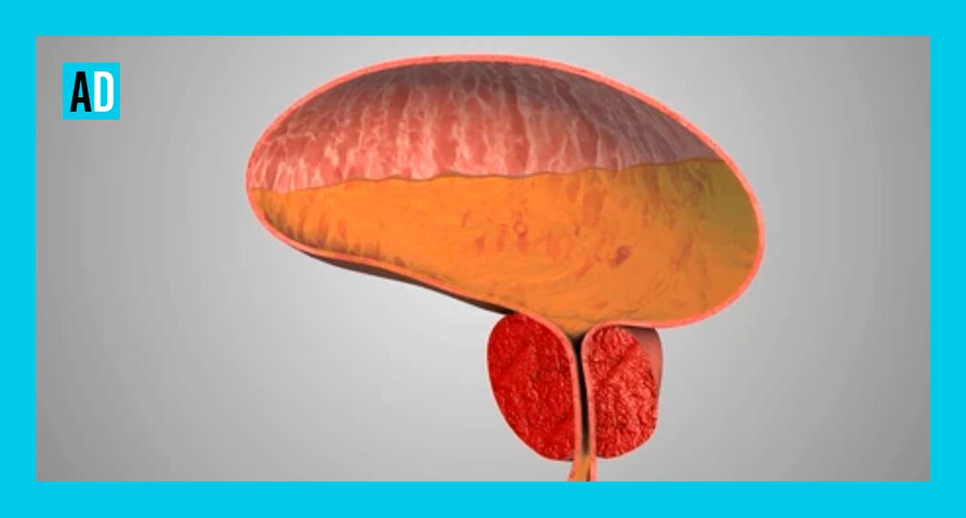 Entzündegt Prostata Drüs